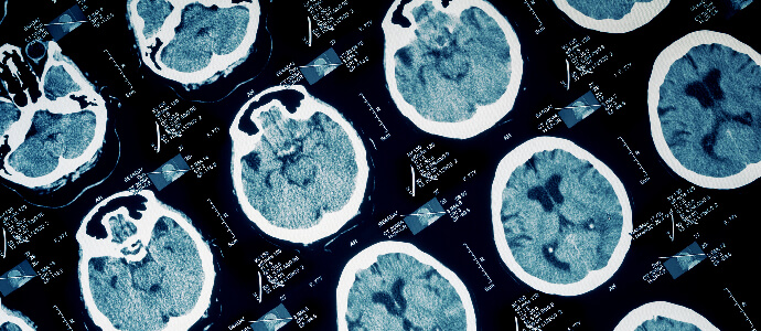 X-RAY scan of brain injury
