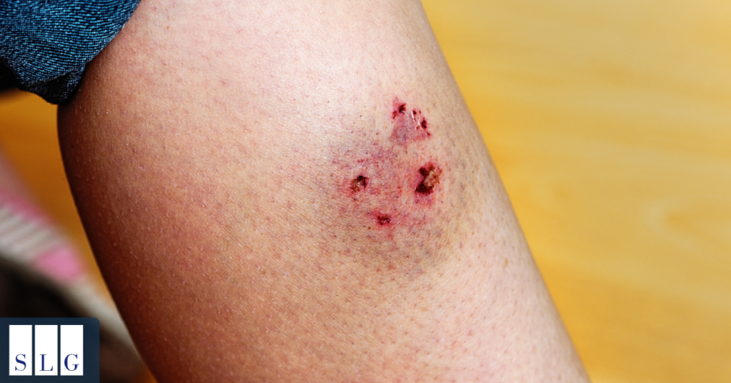 Factors Influencing Level 4 Dog Bite Settlements